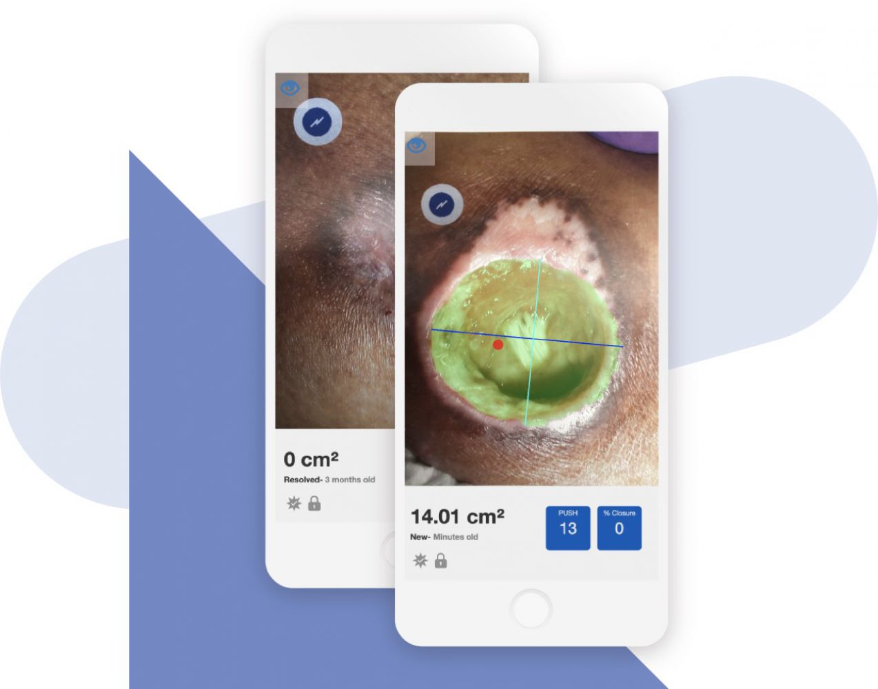Swift Skin and Wound app measuring a wound size