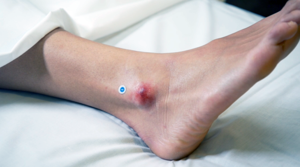 Ankle pressure injury with Swift HealX near the wound